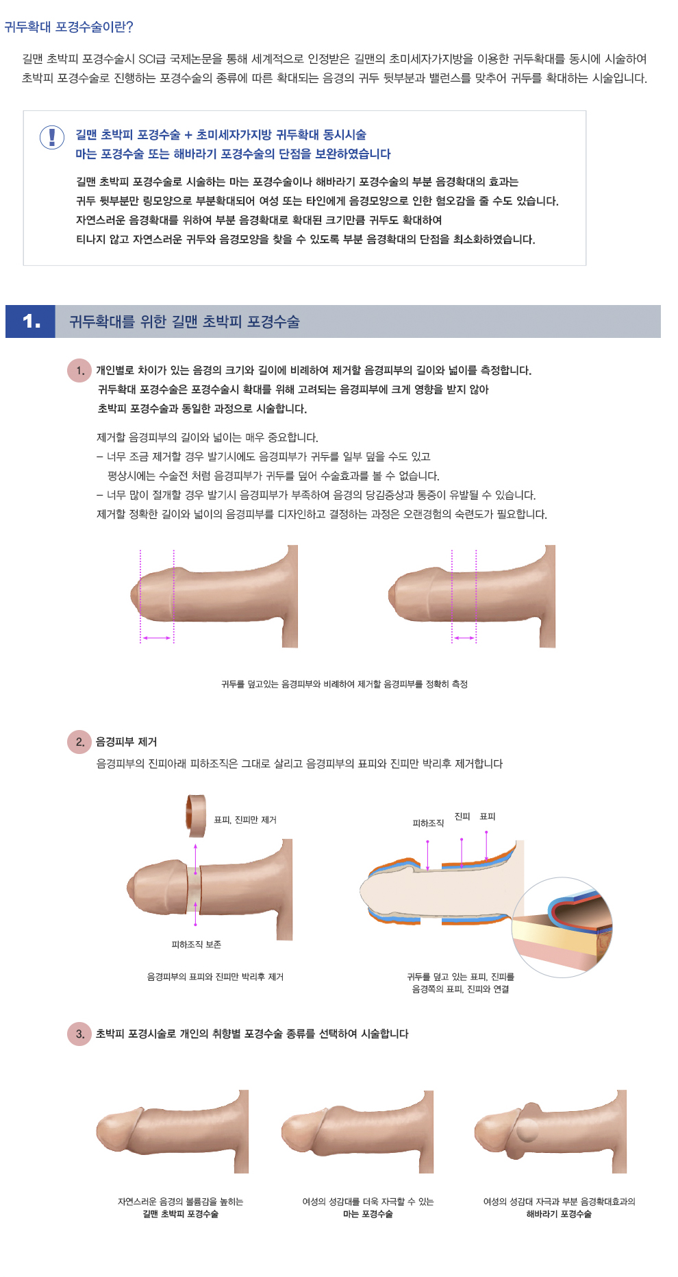 귀두확대포경수술